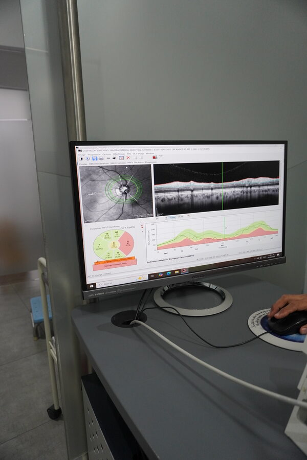 Tomografía de coherencia óptica (OCT)- GLAUCOMA